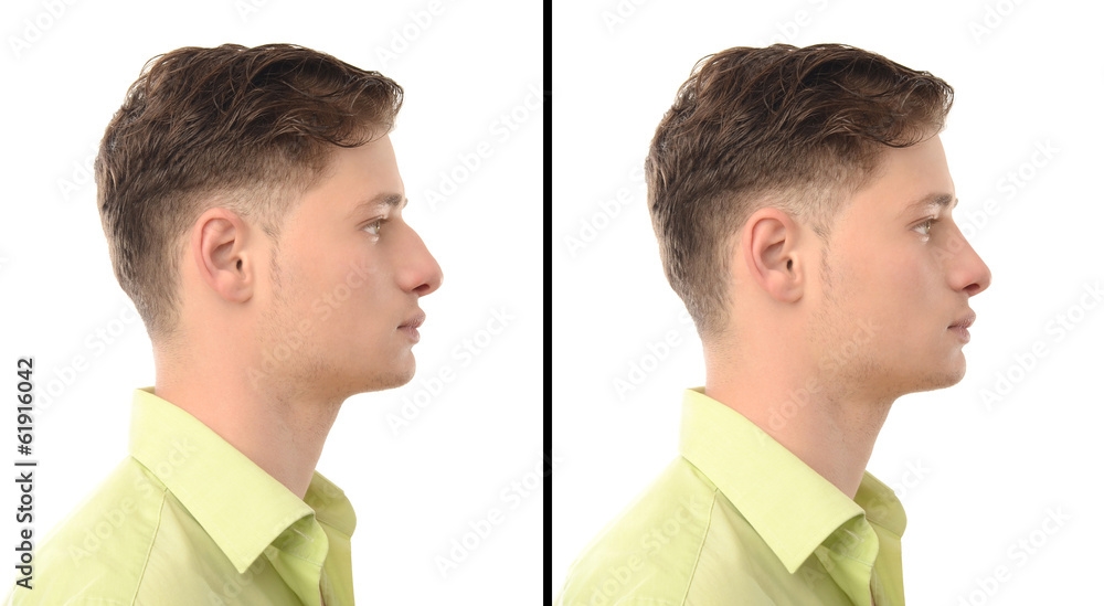 rhinoplasty expert